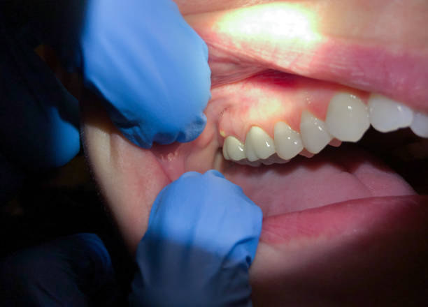Best Emergency Gum Treatment in Sistersville, WV